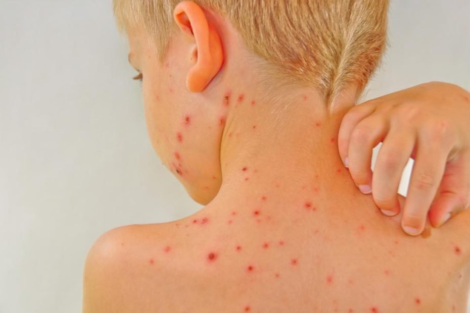 Facts About Chickenpox