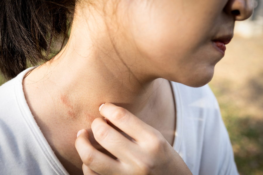 What is Eczema and What Triggers It